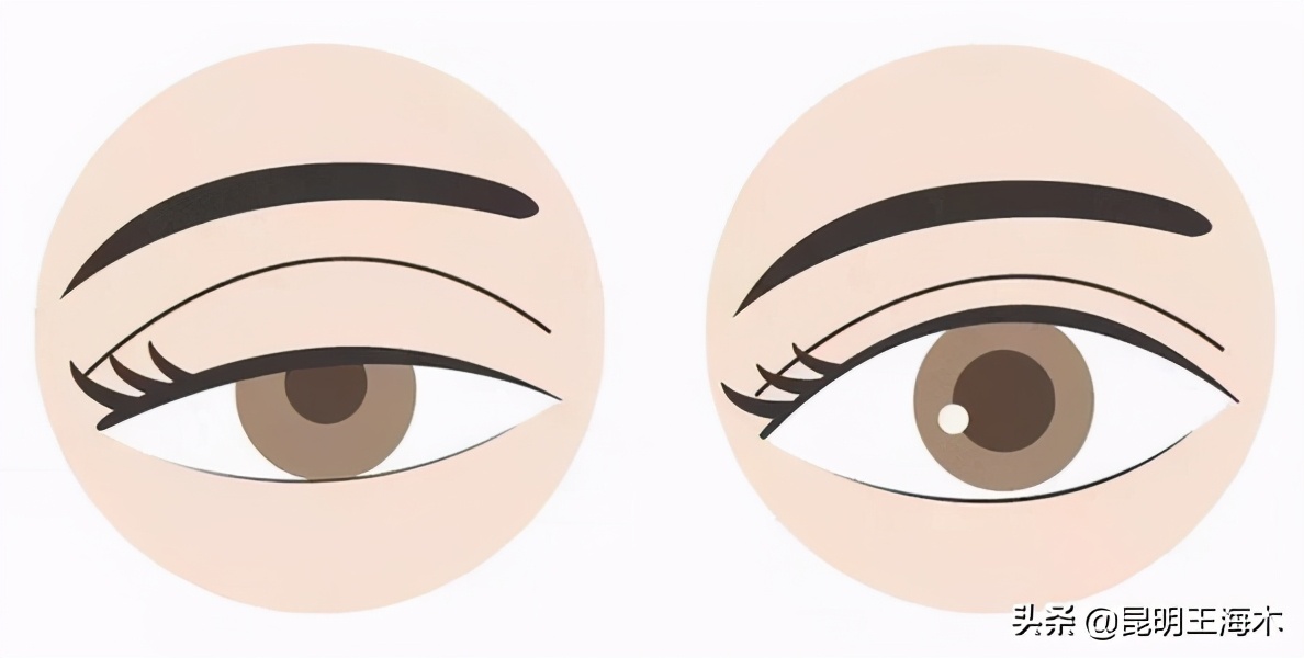 想做双眼皮先看看你适合什么方案,做双眼皮的三种方法你适合哪种