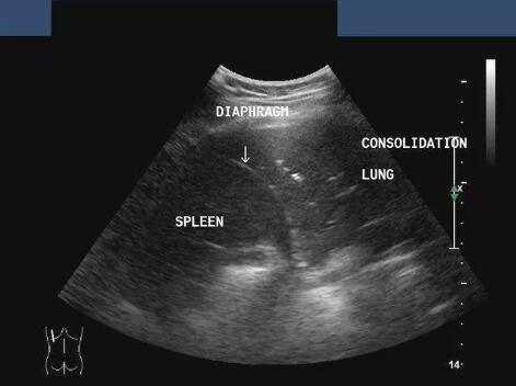 检查手段五花八门该如何抉择?医生教你选择肺癌诊断的最佳手段