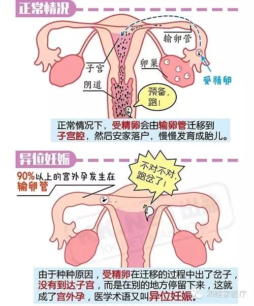 孕卵迷路潜藏危机——出血、腹痛甚至危及生命！