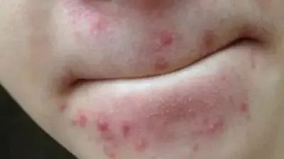 疮是怎么引起的怎么治,长疮的症状和表现有什么