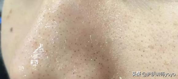 去黑头护肤正确过程,挤黑头之后怎么护肤