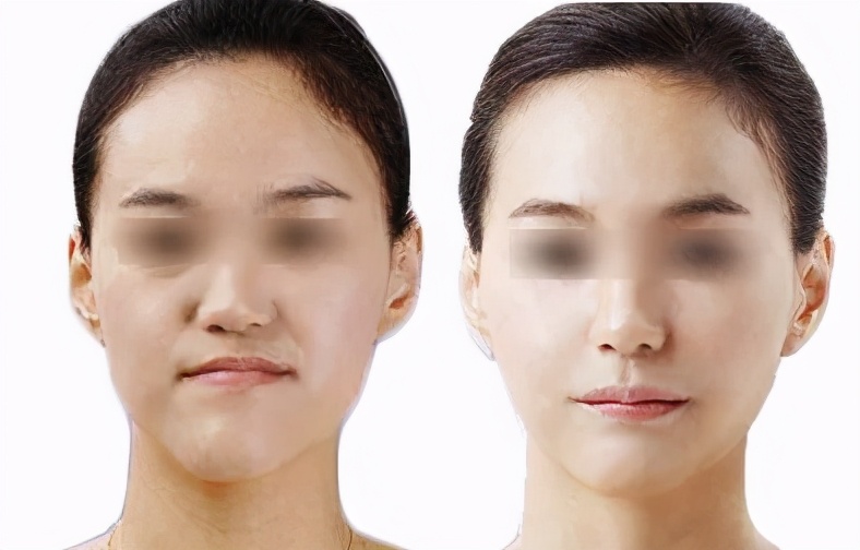 咀嚼导致的大小脸怎么恢复,单侧咀嚼大小脸可以恢复吗