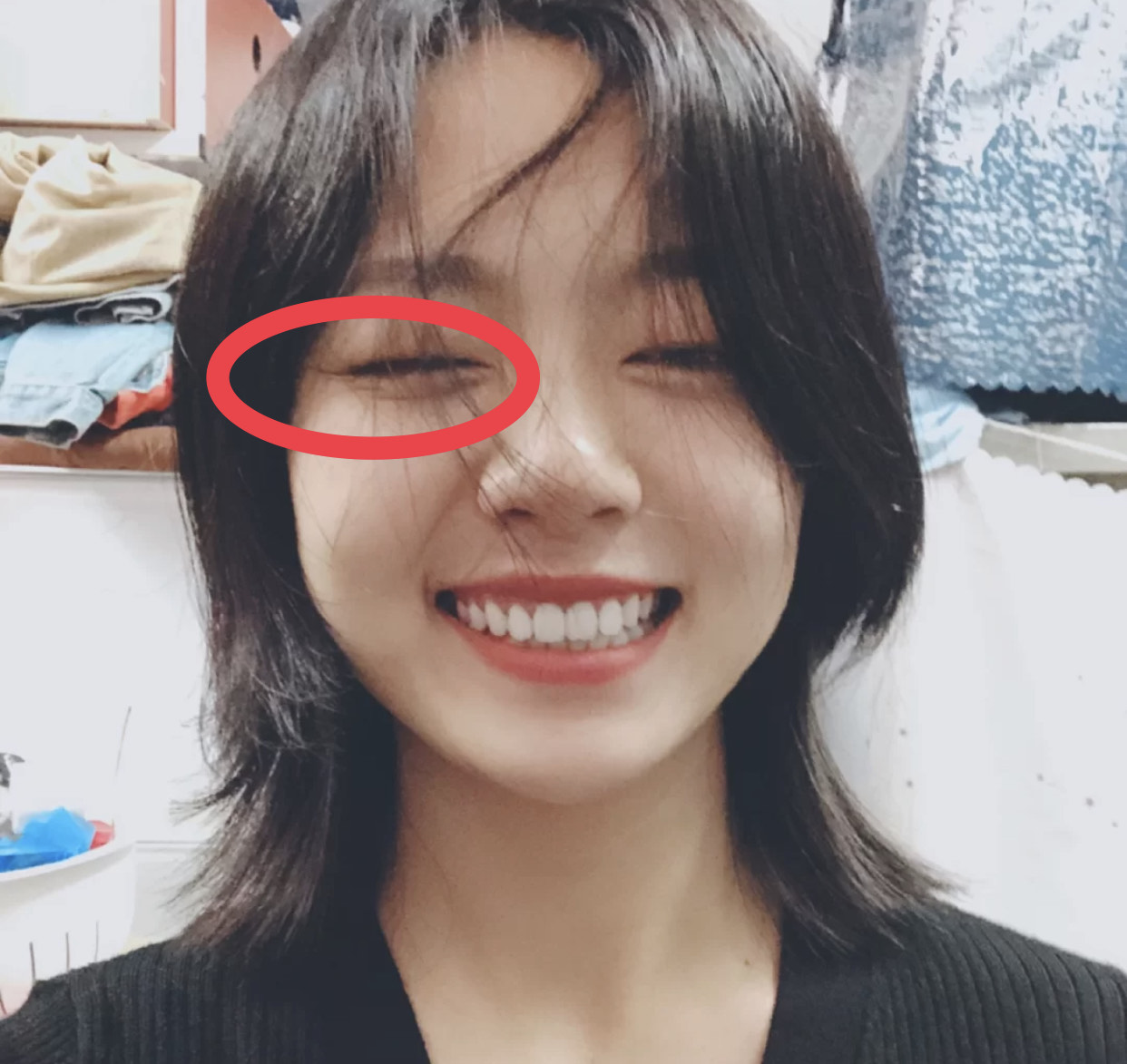 笑起来虽然有点皱纹但更喜欢大笑,一笑脸颊的皱纹很明显怎么办