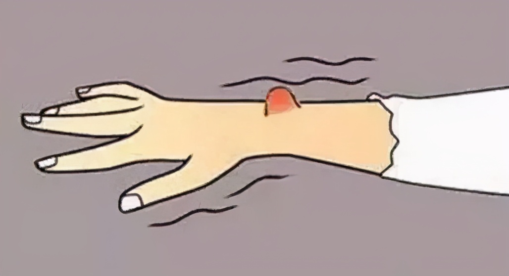 健康小知识之什么是痔疮,健康小知识治疗小病