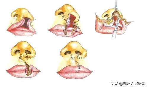 兔唇修复成功视频,完美修复系列
