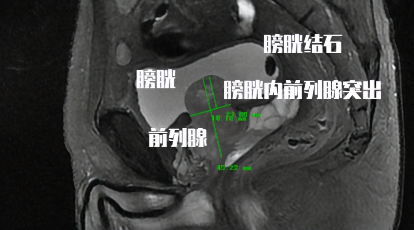 前列腺增生膀胱有余尿如何做手术,前列腺增生是结石吗