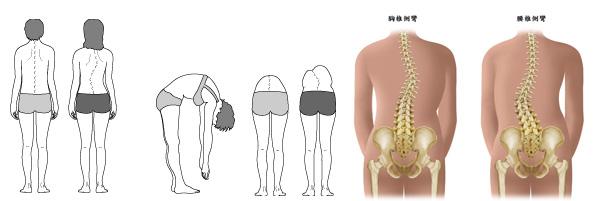 正美体态矫正脊柱侧弯真的有用吗,先天脊柱侧弯体态矫正有用吗