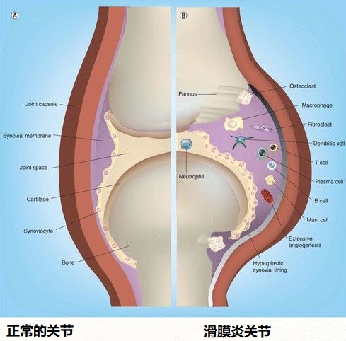 膝盖滑膜炎怎么回事,滑膜炎三大症状