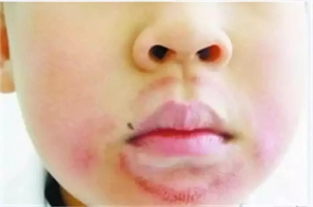 大s去唇干裂小妙招,嘴唇干裂起皮小秘方