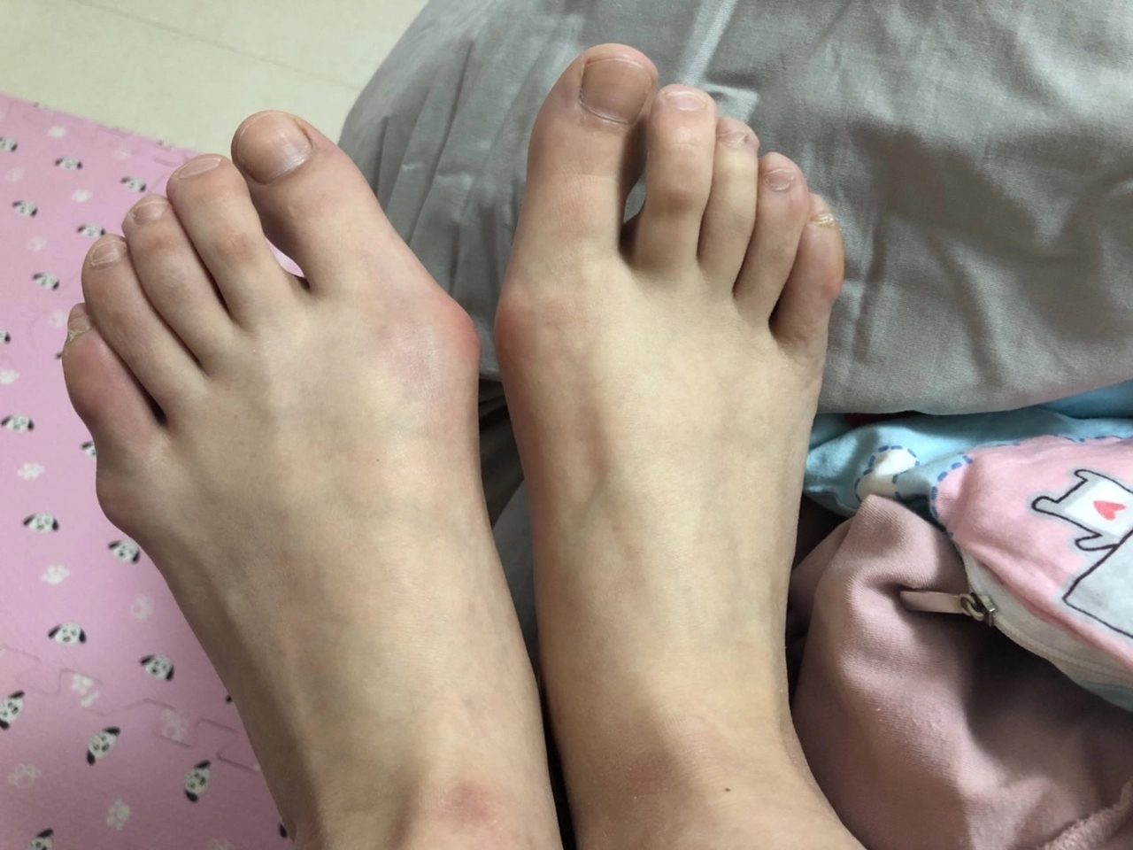 怎么样才能有效解决宽脚,宽脚脚肥怎么解决