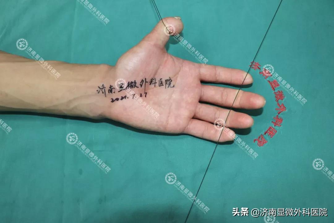 拇指缺失为什么影响这么大？手指再造中心如何找回缺失的手指？
