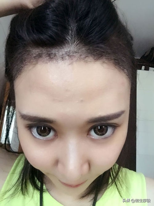 植发后多久可以看到效果,植发后多久能看到效果