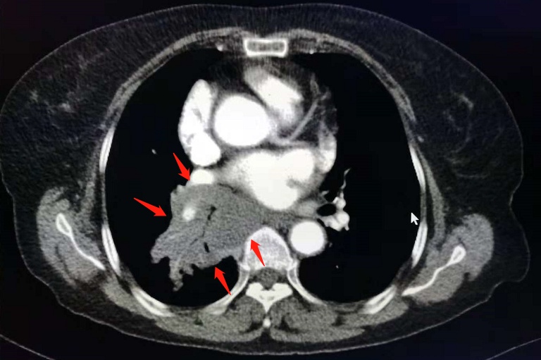 与肺癌病人一起生活需要注意什么,与肺癌抗战的第七个月