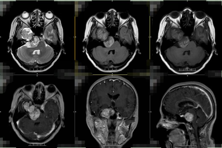 查出恶性肿瘤做手术能好吗,良性脑肿瘤手术费用