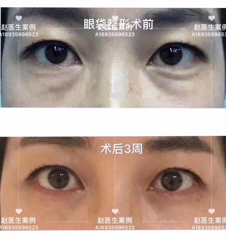 涂眼霜可以祛眼袋？不现实！祛眼袋的三种靠谱方法看这里