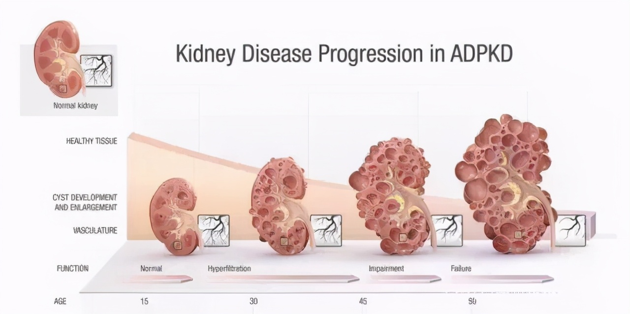 儿童肾病的隐形杀手,毛孩子得什么病