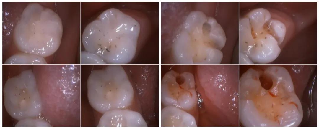 牙科医生检查小朋友口腔,口腔门诊免费窝沟封闭申请