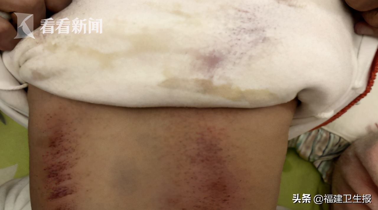 儿童泡过药浴全身像过敏一样,1岁宝宝泡药浴起疹子