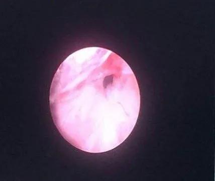 名医札记（二十九）前列腺增生手术失败怎么办?