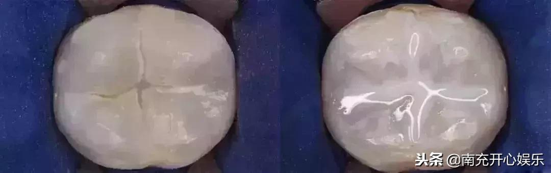 窝沟封闭没了会怎样,小孩有蛀牙可以窝沟封闭吗