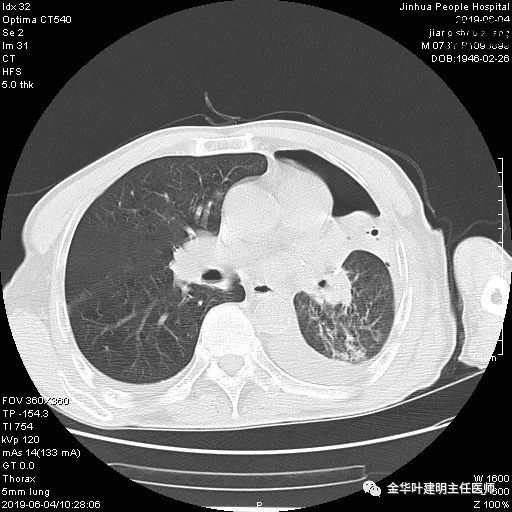 手术引起乳糜胸,有没有做了肺结节手术后是误诊的