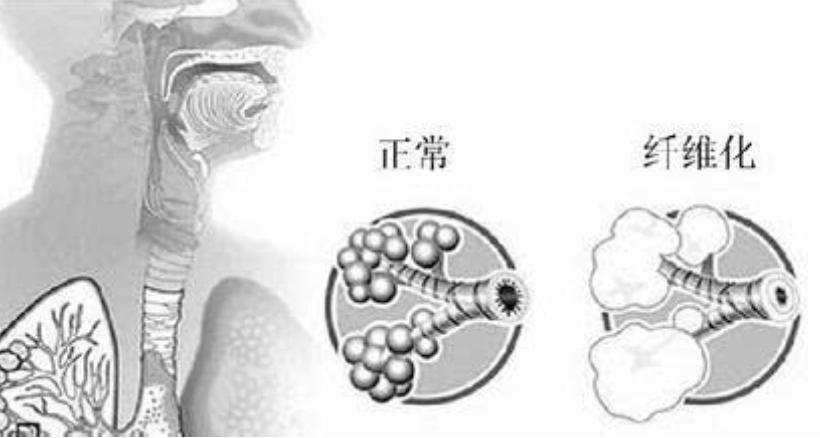 百草枯肺纤维化原理,百草枯为什么会让肺纤维化