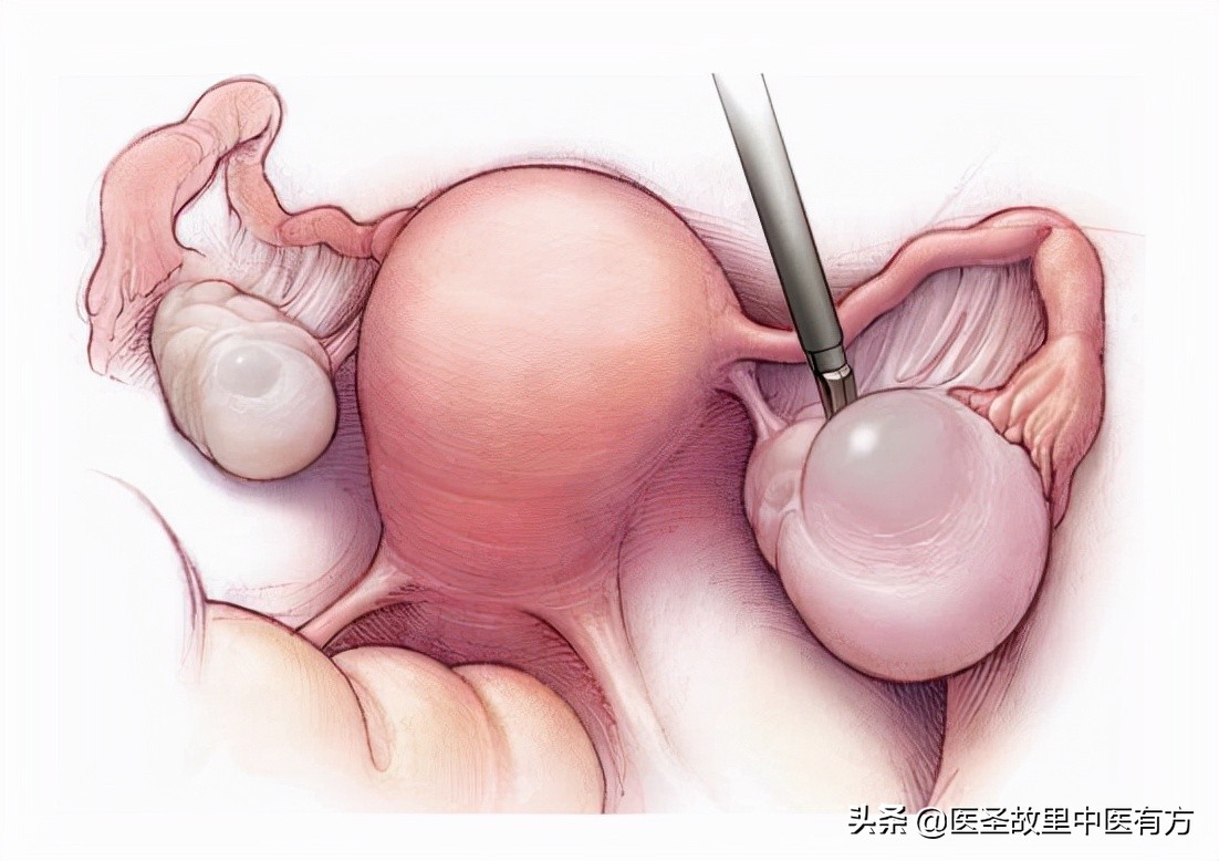 消囊汤组方,民间中药名方消囊汤