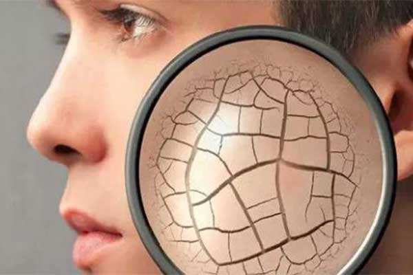 皮肤干燥皲裂,皮肤皲裂怎么快速恢复