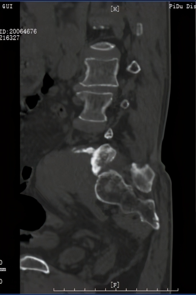 罕见肿瘤中医治疗案例视频,罕见肿瘤中医治疗案例