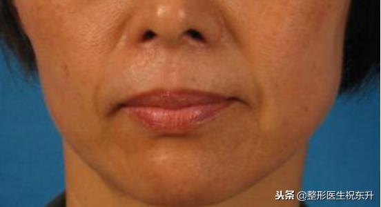 鼻唇沟泪沟法令纹,18岁有眼沟纹和法令纹怎么办