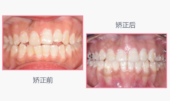 单颗牙隐形矫正,郑州隐形矫正牙齿哪家便宜