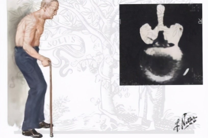 腰椎管狭窄症是怎么回事儿（二）该保守还是要手术呢？