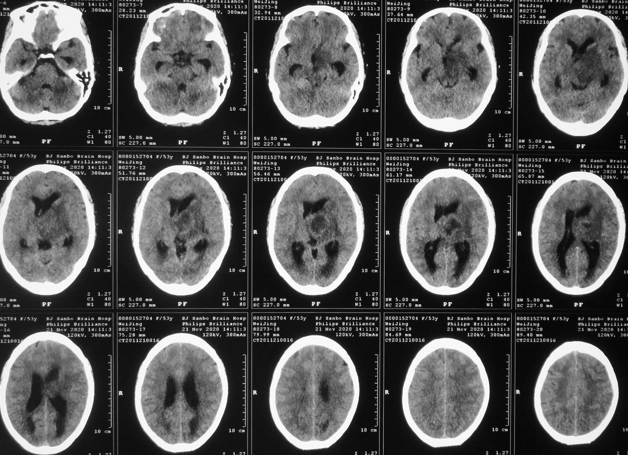 脑脓肿合并脑膜炎需要手术吗,脑脓肿进入左侧脑室严重吗