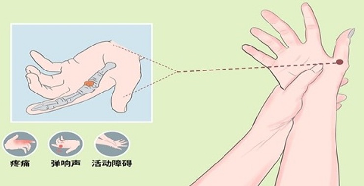 小儿狭窄性腱鞘炎应该怎么办？