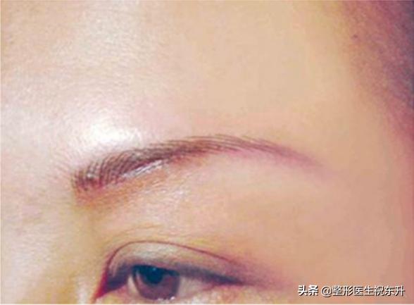 眉下提拉术,眉下提眉术后效果图