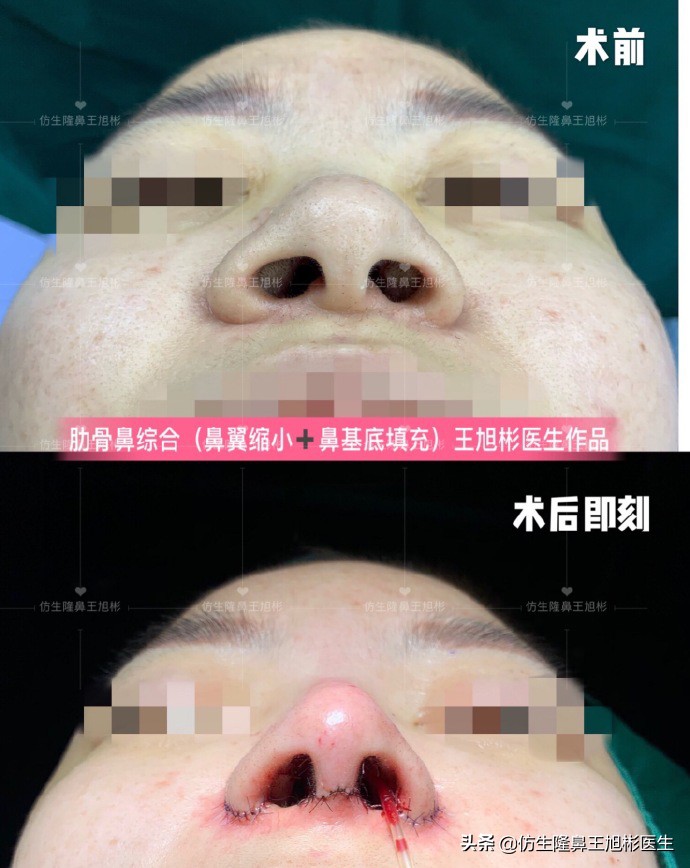 隆鼻鼻头大是失败了吗,大鼻头隆鼻手术案例