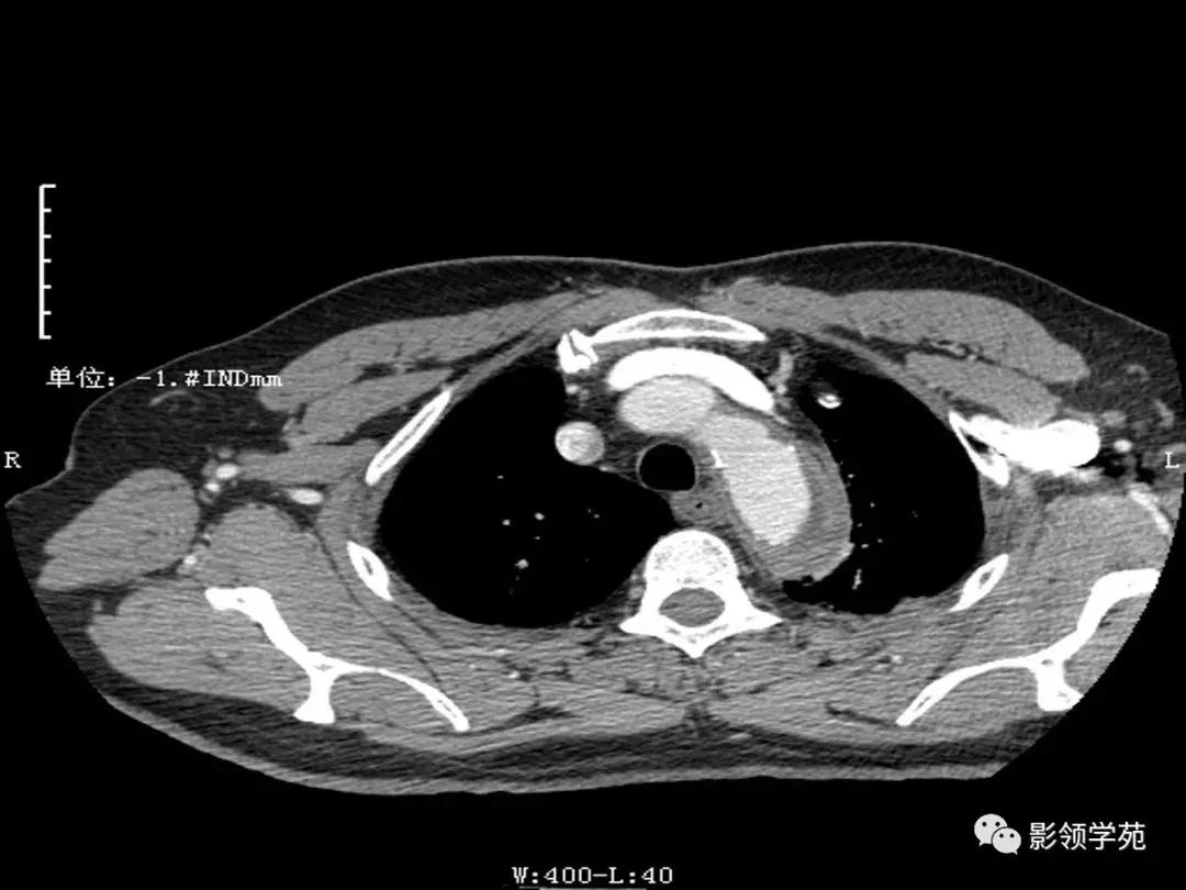 主动脉壁间血肿护理查房,主动脉夹层和壁间血肿图片