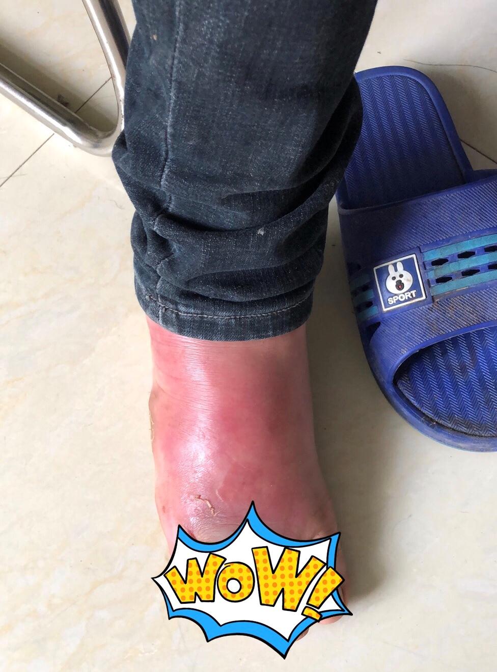 糖尿病病足破溃处怎么描述,糖尿病患者下肢溃烂吃什么药