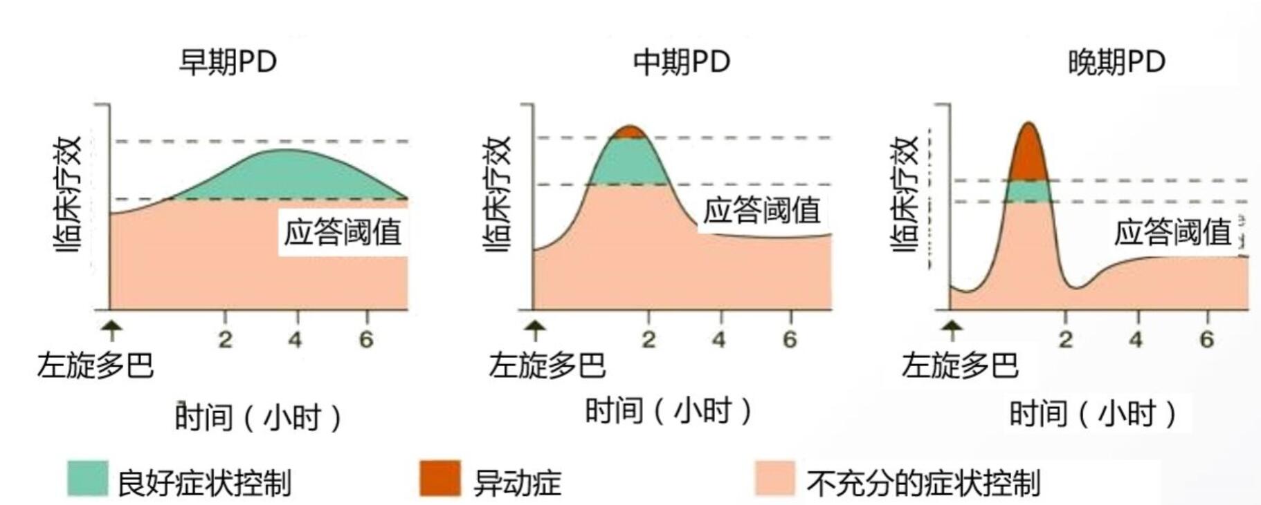 dbs能改善帕金森患者异动症吗,帕金森异动症有多可怕