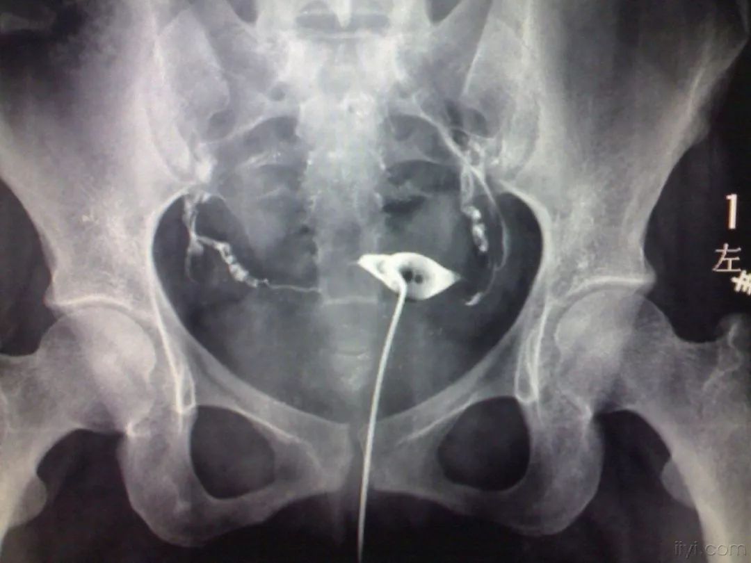 没做过人流，为何也成为输卵管堵塞的受害者？