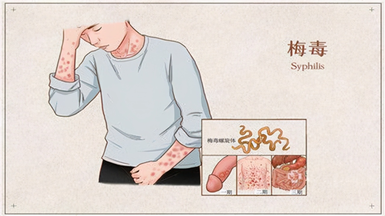 得了梅毒好得快牢记这5点,梅毒致死率多少