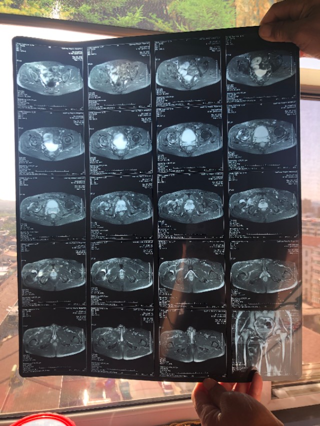 股骨头坏死医院怎么样治疗,股骨头无菌性坏死病因是多少种