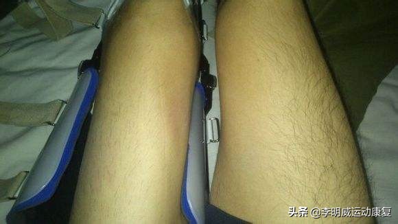 半月板撕裂一年多后康复训练,半月板撕裂恢复的最好办法