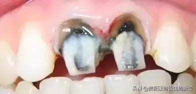 烤瓷牙做过后最好的修复方法,烤瓷牙里面的真牙烂了怎么办