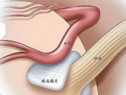 面肌痉挛右眼皮跳北京哪里治疗,眼皮一直抽搐跳动的原因面肌痉挛