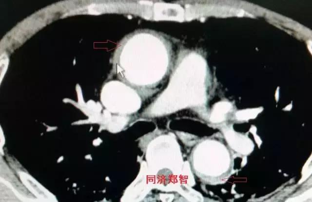 磁共振可以替代cta检查主动脉夹层,超声心动图联合cta诊断主动脉夹层