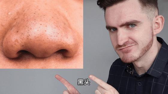 去黑头的最好方法在家操作,推荐一些在家就能去黑头的办法