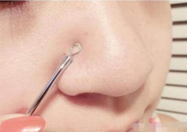 鼻子挤出来的白色条状怎么去干净,鼻子上挤出的白色条状怎么解决