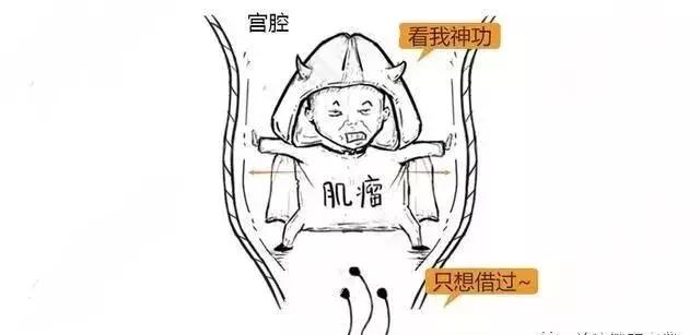 漫画详解子宫肌瘤是个啥?