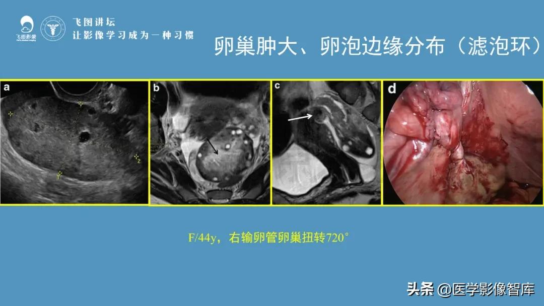子宫解剖结构输卵管和卵巢位置,子宫附件ct影像学正常解剖表现